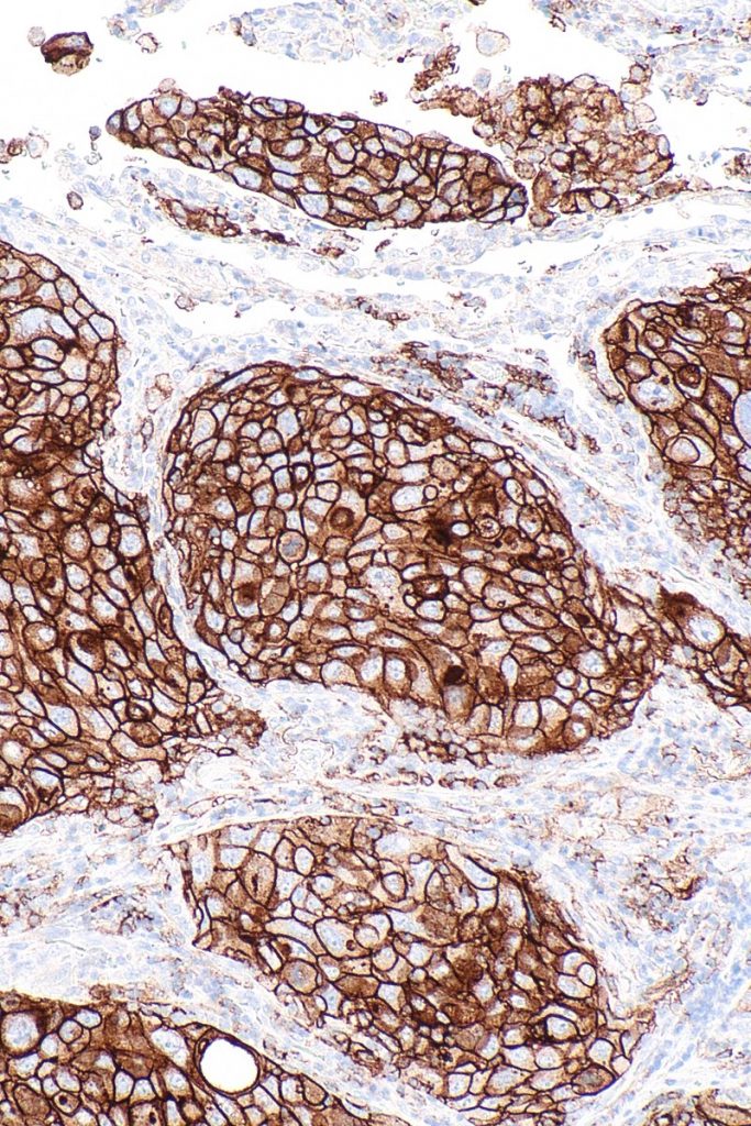 PD-L1 positive NSCLC stain Source: CC BY-SA 4.0