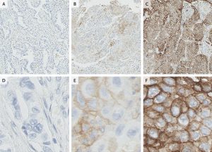 PD-L1 Expression in Non–Small-Cell Lung Cancers
